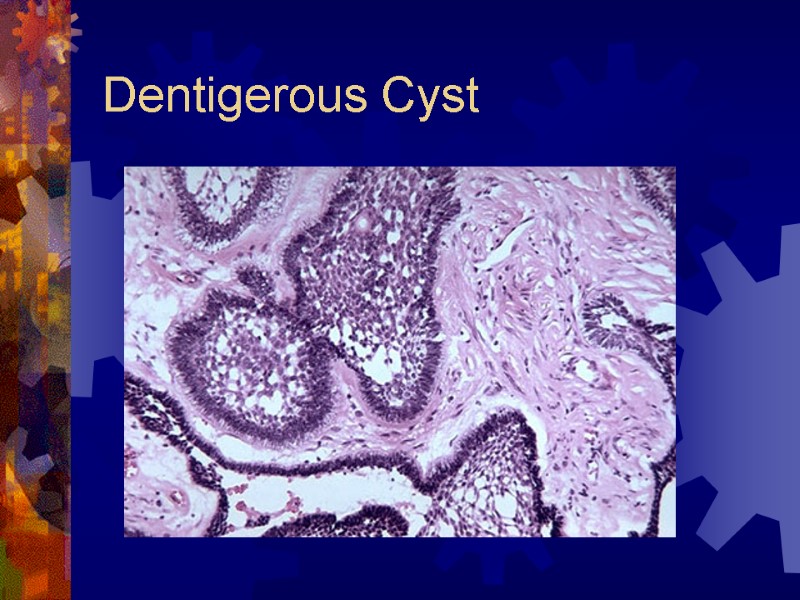 Dentigerous Cyst